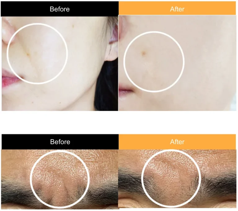 Før og etter Acropass Retinol, etter 4 uker